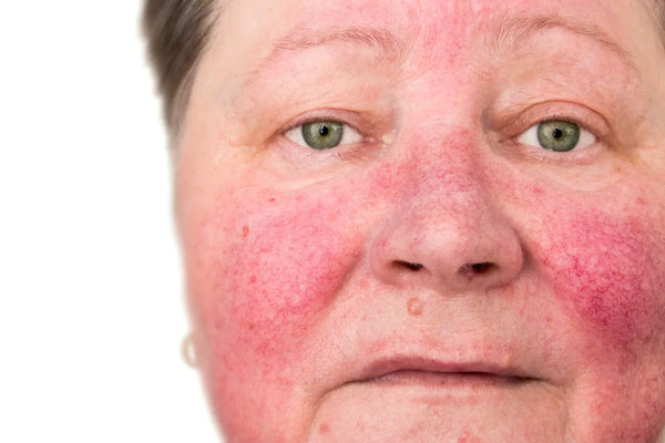 Facial Redness After Alcohol: Why Some People Flush(and others don't)