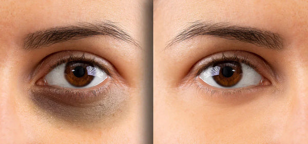 Do Vitamin C, Zinc, or Iron Deficiencies Cause Dark Circles? What the Evidence Says