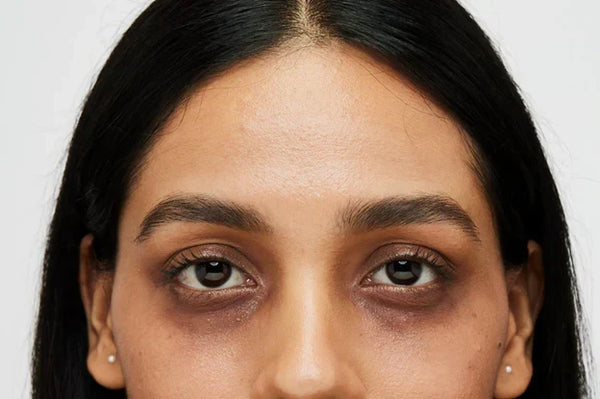 Why Do I Have Dark Circles? The Different Types, Explained