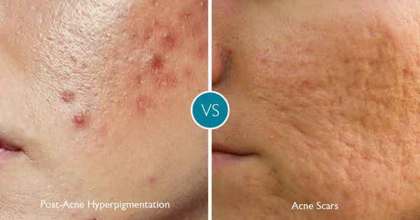Should You Pop Pimples? Scarring, Hyperpigmentation & Appearance Risks