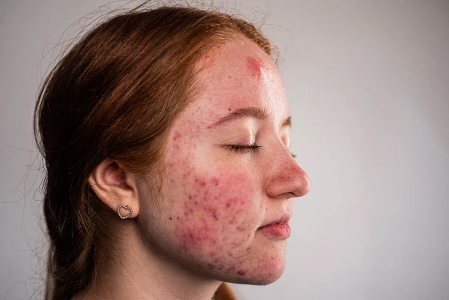 7 Signs of a Damaged Skin Barrier