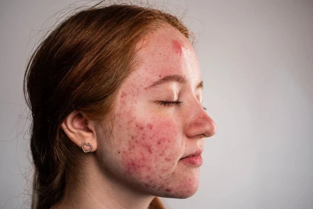 7 Signs Your Skin Barrier Is Damaged (And How to Help It Recover) - Boldpurity Skincare
