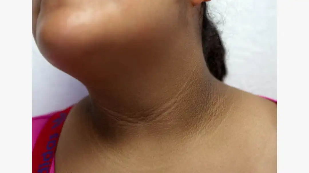 Acanthosis nigricans showing dark, thickened and velvety skin associated with insulin resistance