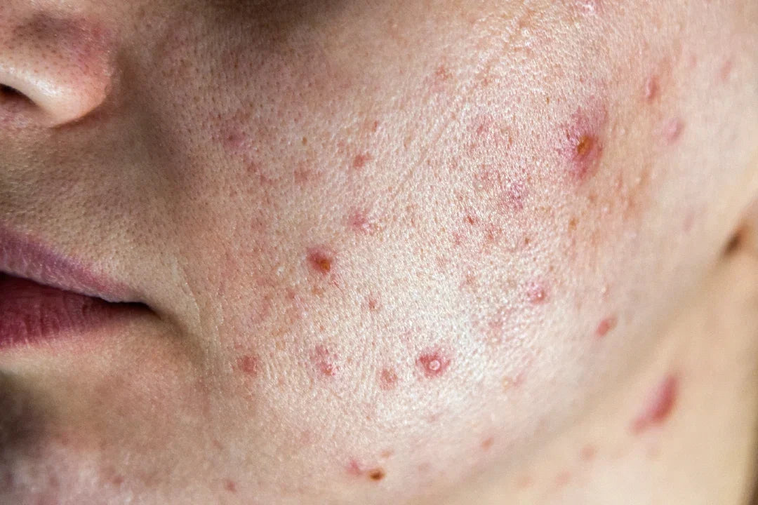  "C. acnes is a normal part of everyone's skin microflora" 