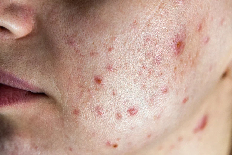Is Acne Contagious? (myth-buster)