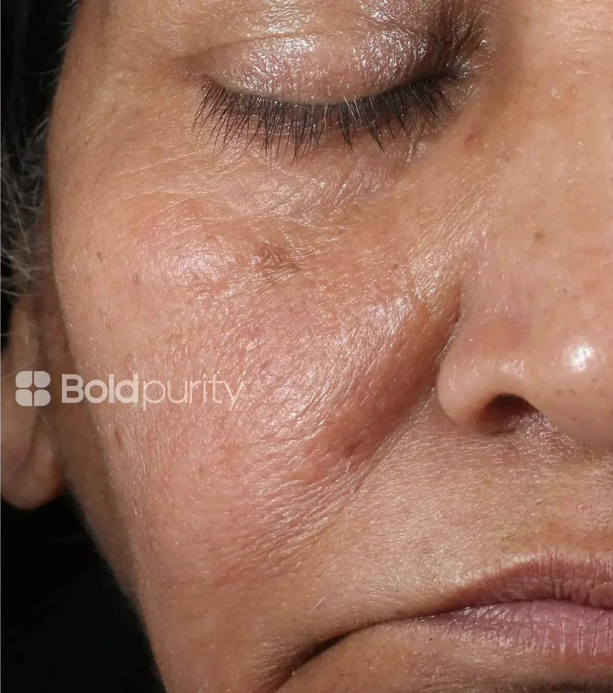 Close-up of a participant's cheek and under-eye area after 8 weeks of using Boldpurity SkinReset™ serum in an independent clinical study.