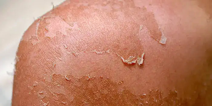 Desquamation process showing skin cell shedding, stratum corneum and skin renewal