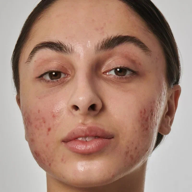 "Red acne marks caused by dilated blood vessels — vascular acne marks"