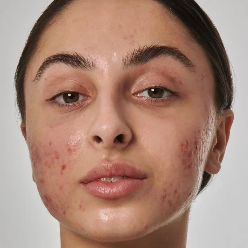 "Red acne marks caused by dilated blood vessels — vascular acne marks"