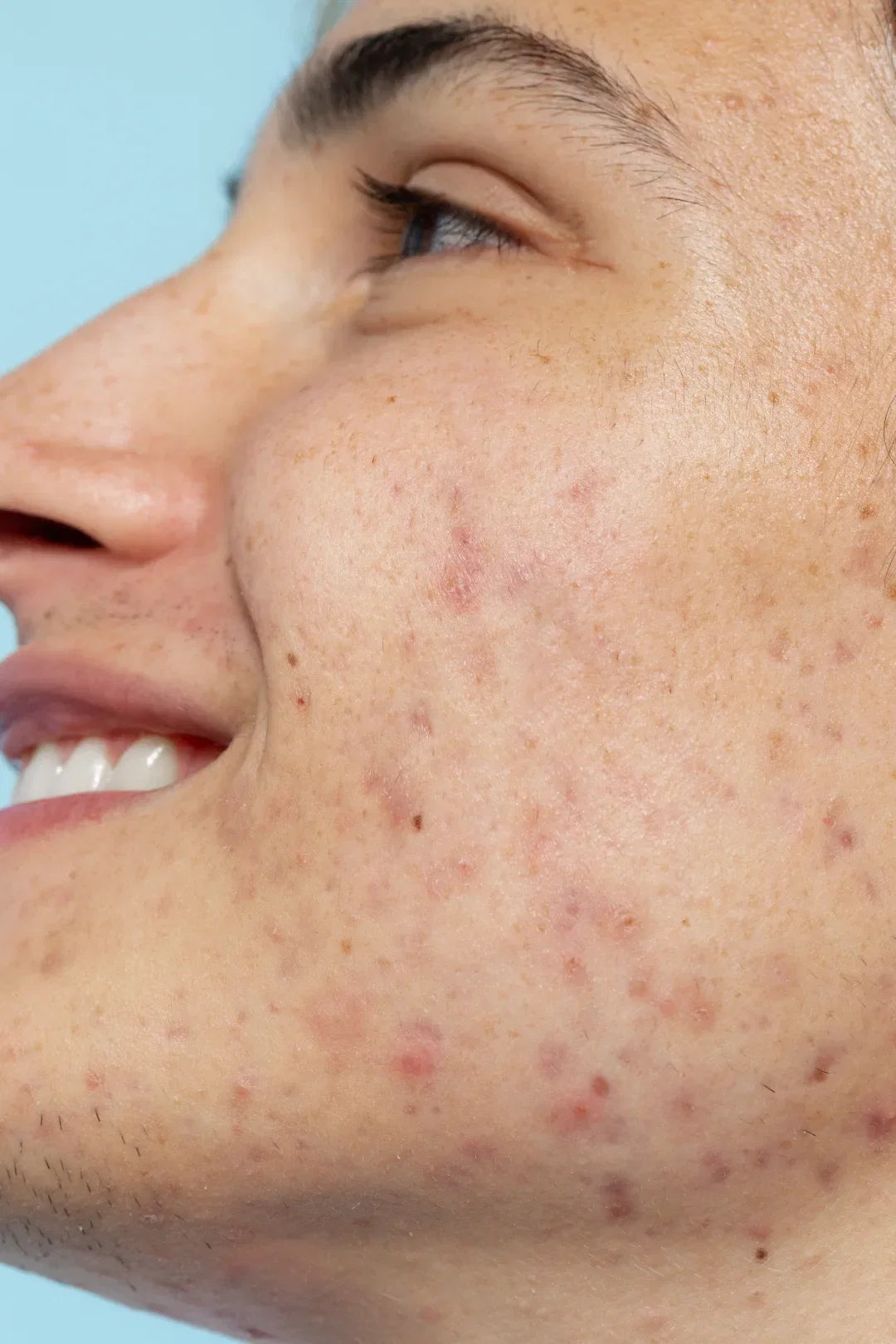Close-up of facial acne marks and post-inflammatory hyperpigmentation (PIH), showing uneven skin tone after acne.