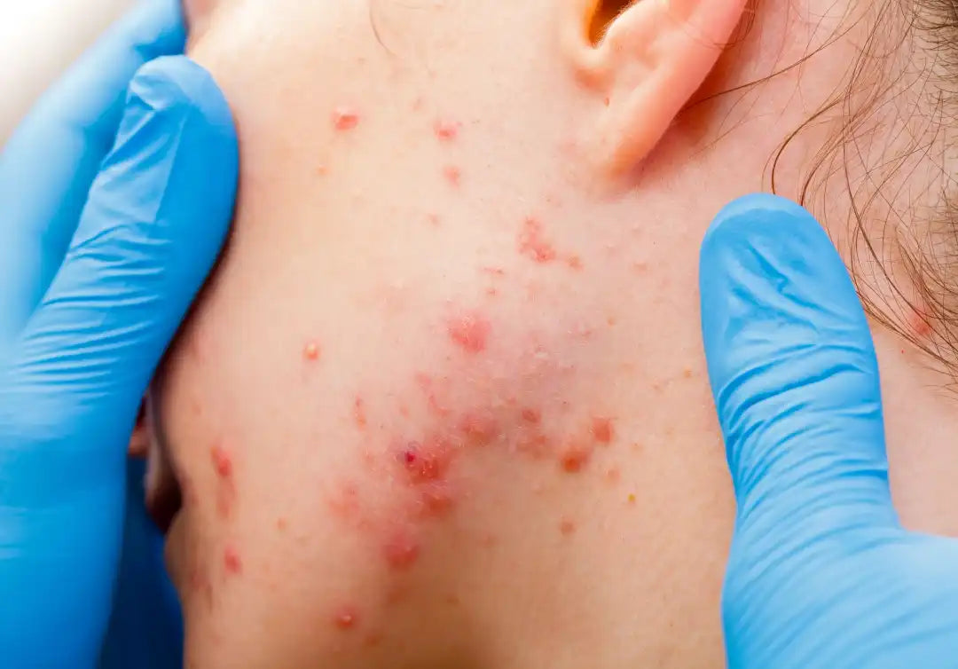 Inflammatory acne showing immune signalling, cytokines and neutrophil response