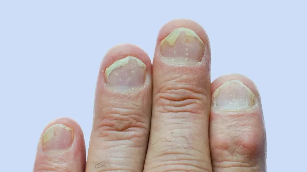Nail psoriasis showing changes in fingernails