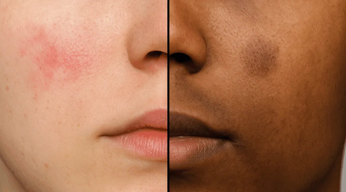 "Post inflammatory hyperpigmentation — brown spots after acne" post-inflammatory-erythema-red-acne-marks.