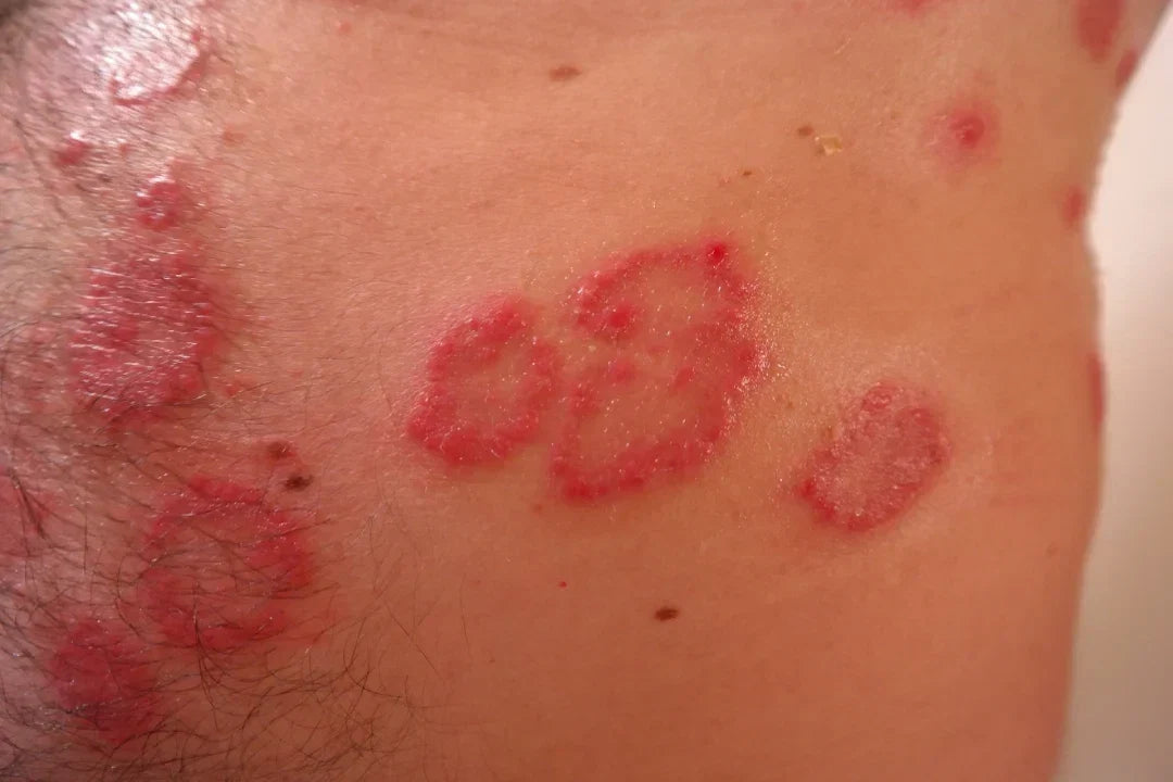 Common psoriasis triggers: infection, skin injury, medications, stress"