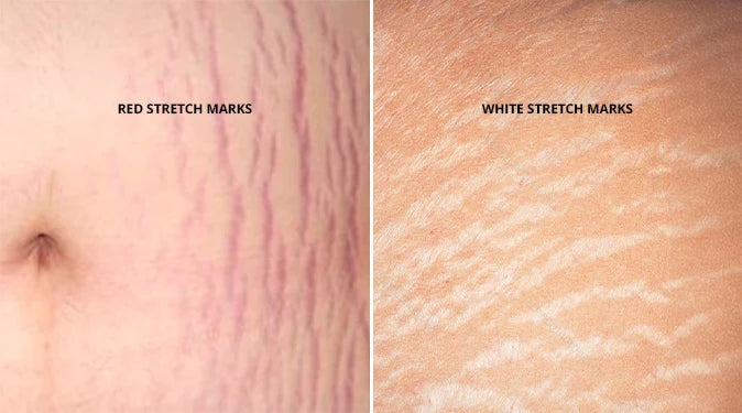 "Close-up showing red stretch marks versus white stretch marks during different healing stages."