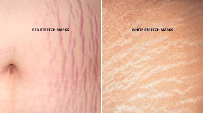 "Close-up showing red stretch marks versus white stretch marks during different healing stages."