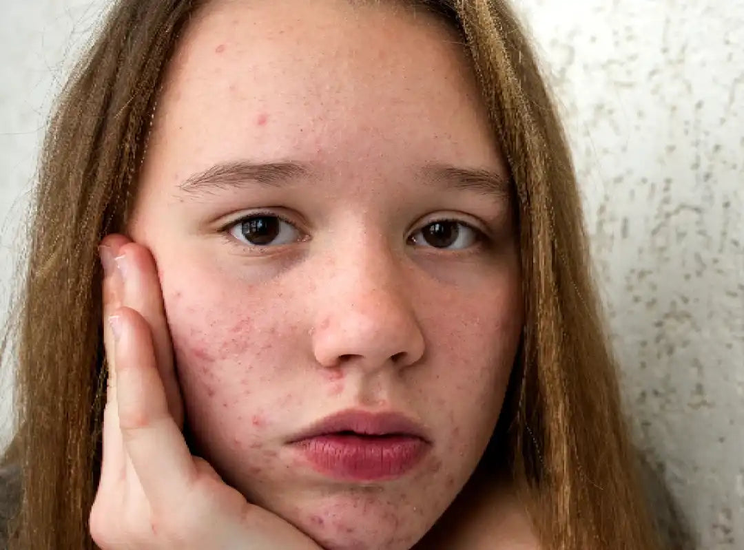 Teenager with acne illustrating puberty-related skin changes and acne pathogenesis