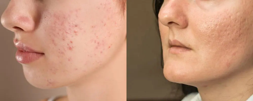 "Acne marks (flat, fading) versus true textural acne scars"