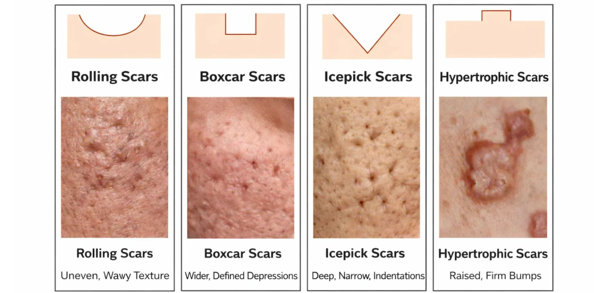 ACNE SCARRING TYPES & MECHANISMS: THE SCIENCE EXPLAINED - Boldpurity Skincare