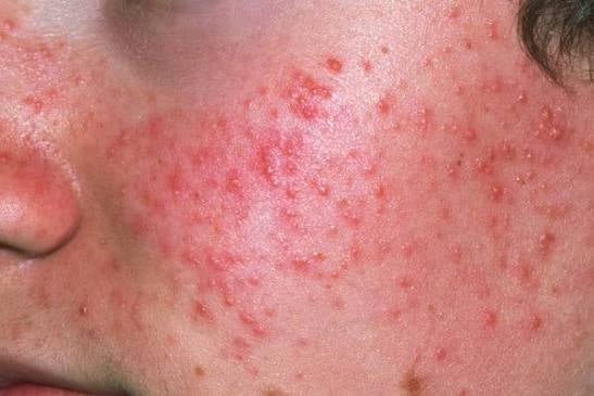Acne on facial skin showing common types of acne and blemishes
