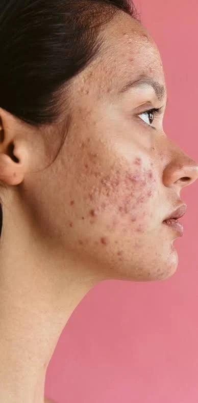 Consulting a dermatologist about persistent acne"