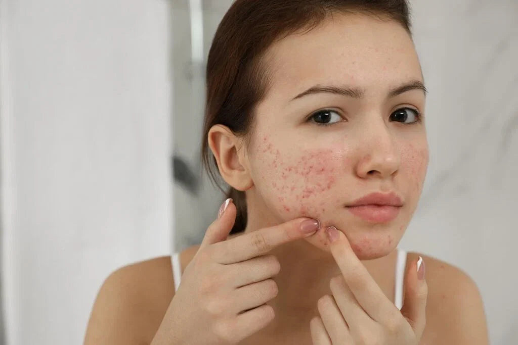 Picking acne spots can cause infection, marks and scars"  
