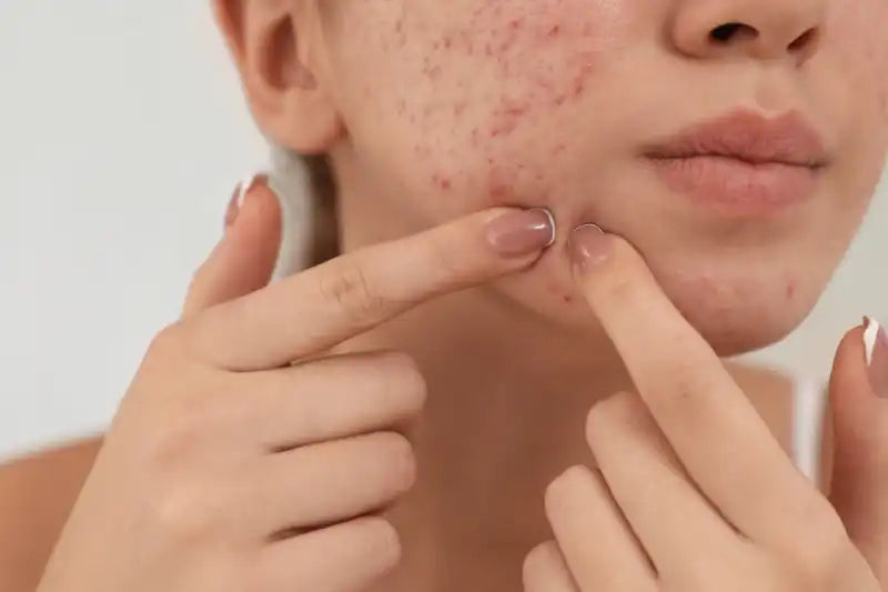 Acne pathogenesis diagram showing sebum, Cutibacterium acnes, inflammation and follicular keratinisation