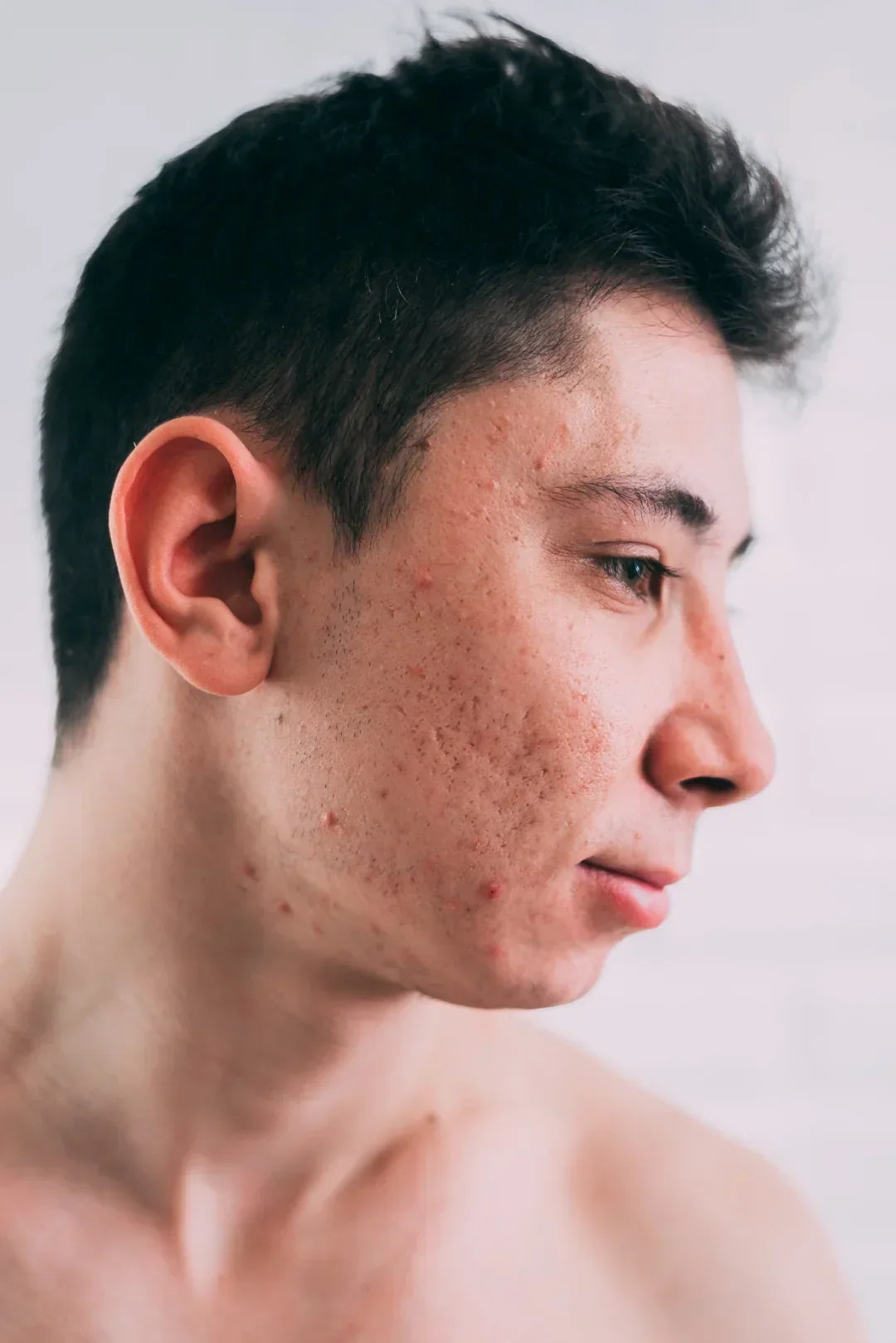 Close-up of facial acne scars, post-acne marks, and uneven skin texture on the cheek, illustrating common acne scarring before treatment.