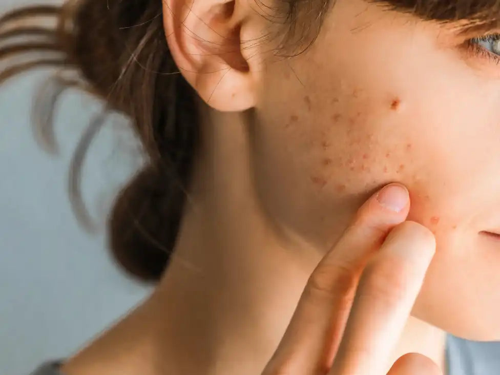 Acne breakout versus allergic skin reaction showing differences in lesion appearance and distribution