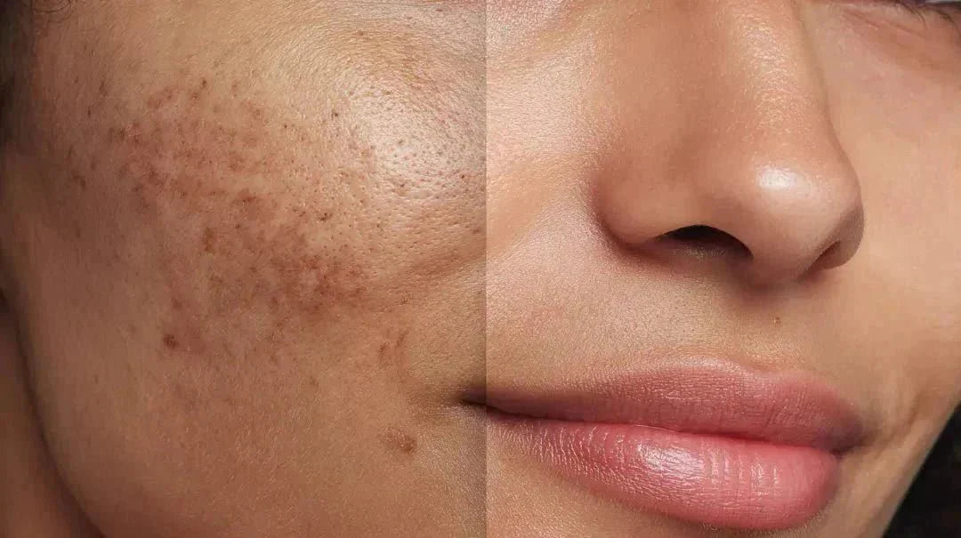 Alpha-Arbutin for Skin: What It Is, How It Works & Dark Spot Science | Boldpurity – ingredient hero