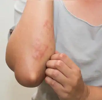 Atopic dermatitis and filaggrin deficiency: skin barrier dysfunction explained
