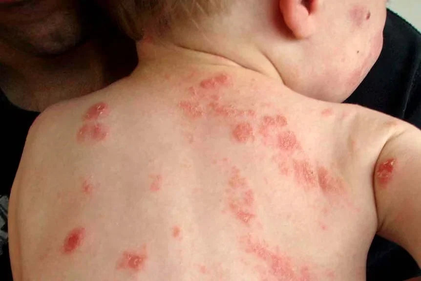 Baby eczema on deeper skin: scaly patches rather than red"