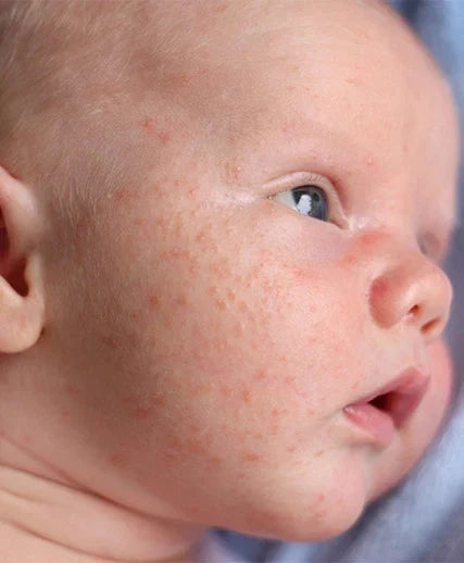 Neonatal baby acne — small bumps on a newborn's cheeks