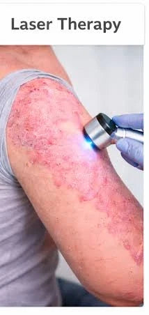 How psoriasis biologics work: blocking TNF-alpha, IL-23 or IL-17 signals"