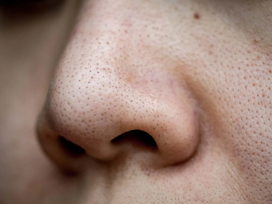 Why You Shouldn't Pop Your Blackheads (and What to Do Instead)