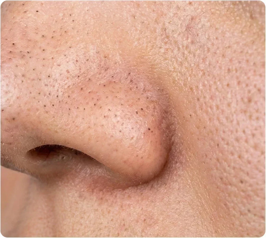 Blackheads: What They Are, How to Remove & Prevent Them