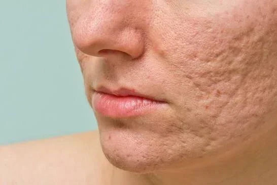 A Gentle Routine for Blemish-Prone Skin