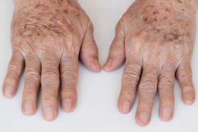 "Brown spots on the hands caused by sun exposure and skin ageing."