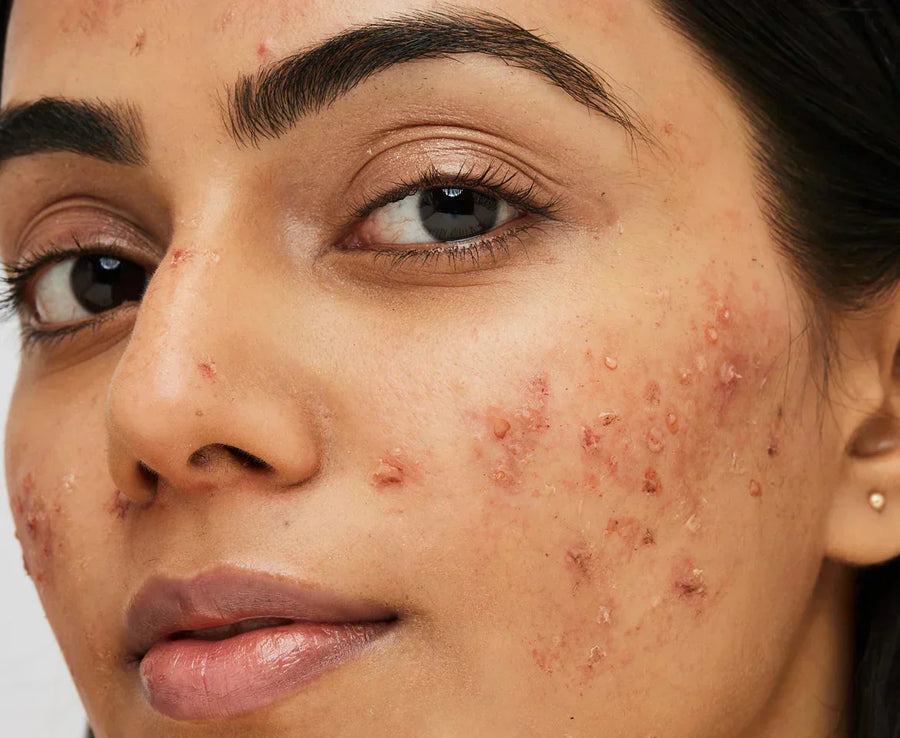 Can Comedogenic Products Cause Breakouts? The Science Behind Pore-Clogging Skincare