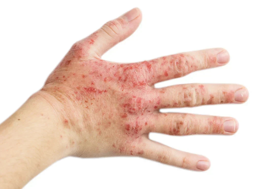"Four causes of eczema: genetics, skin barrier, immune response and triggers"