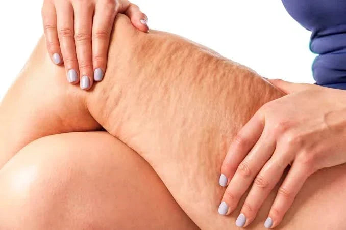 Close-up view of natural cellulite texture on thigh skin showing the appearance of skin dimpling