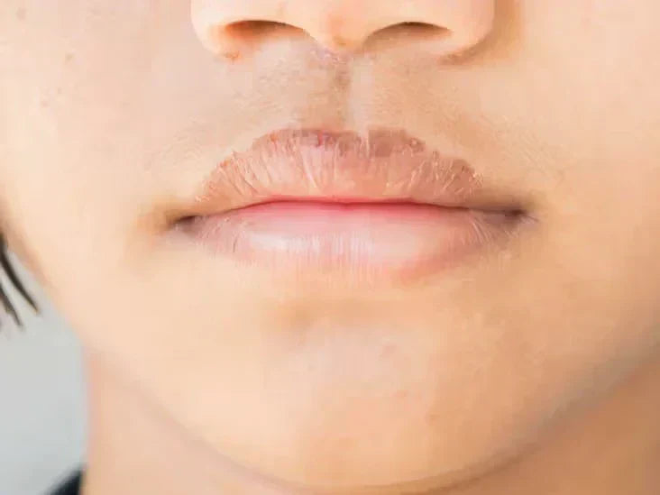 Chapped Lips: Everyday Care and When to See a Doctor 