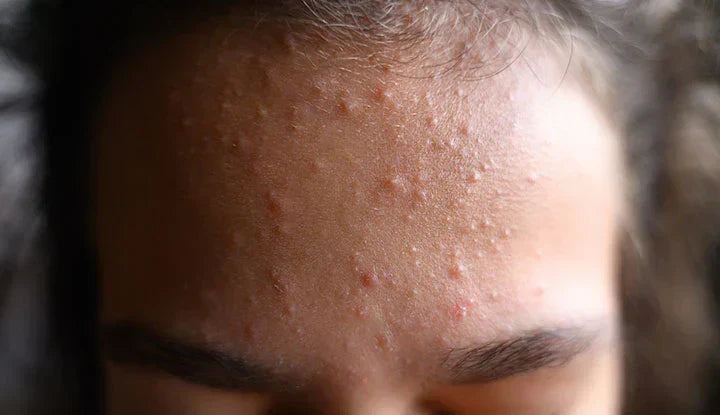 What Are Comedones? Blackheads and Whiteheads, Explained