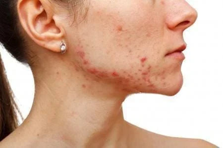 Does Chocolate Cause Acne? What the Science Actually Says