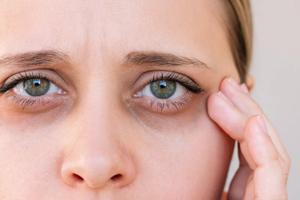 Do Vitamin C, Zinc, or Iron Deficiencies Cause Dark Circles? What the Evidence Says