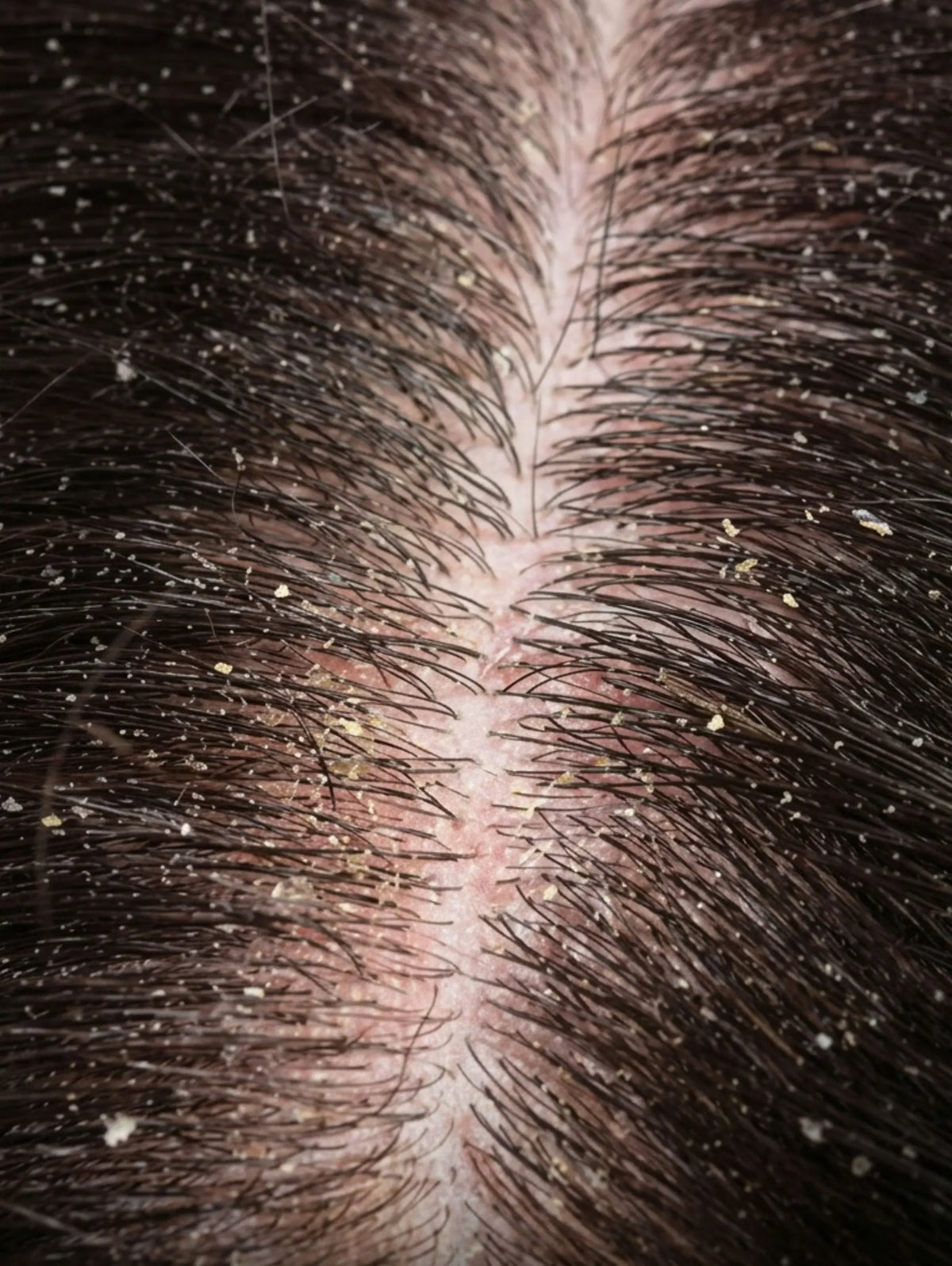 "Applying a medicated antifungal shampoo to the scalp with contact time"