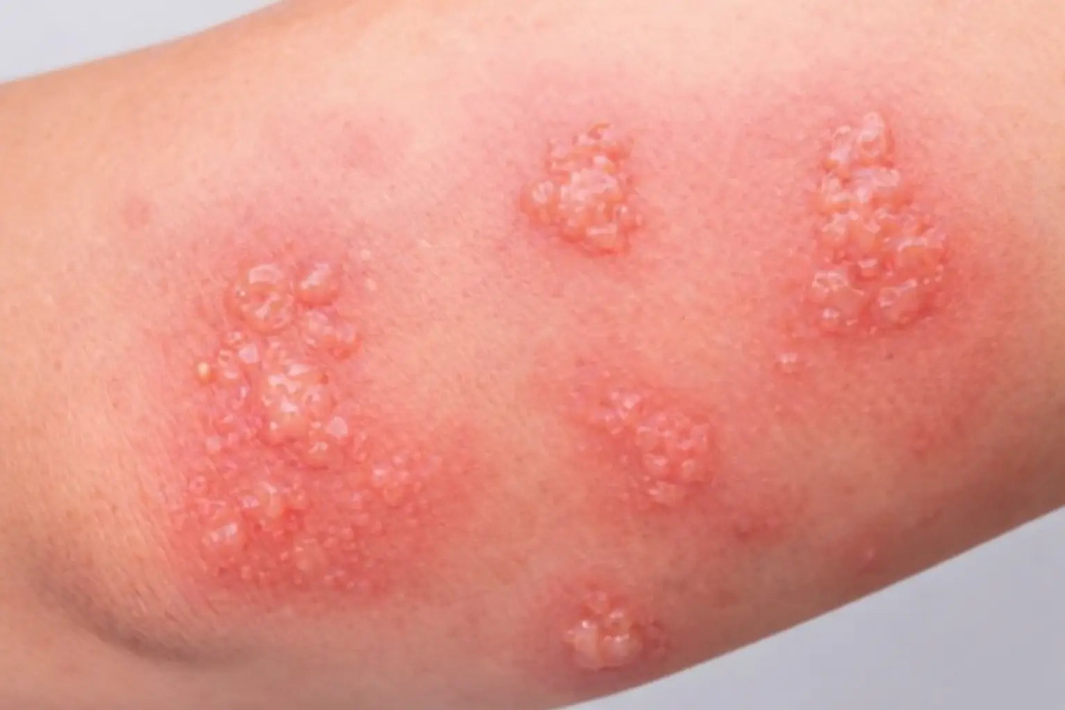 Applying an emollient moisturiser to eczema-prone skin — the cornerstone of management"