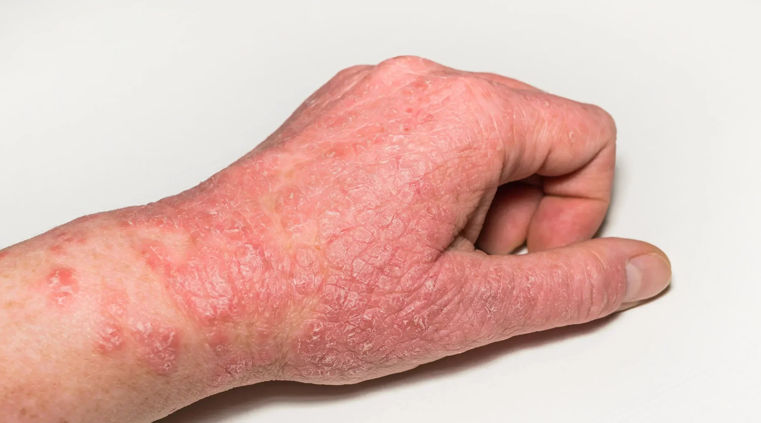 "Eczema on deeper skin, appearing brown-grey rather than red"