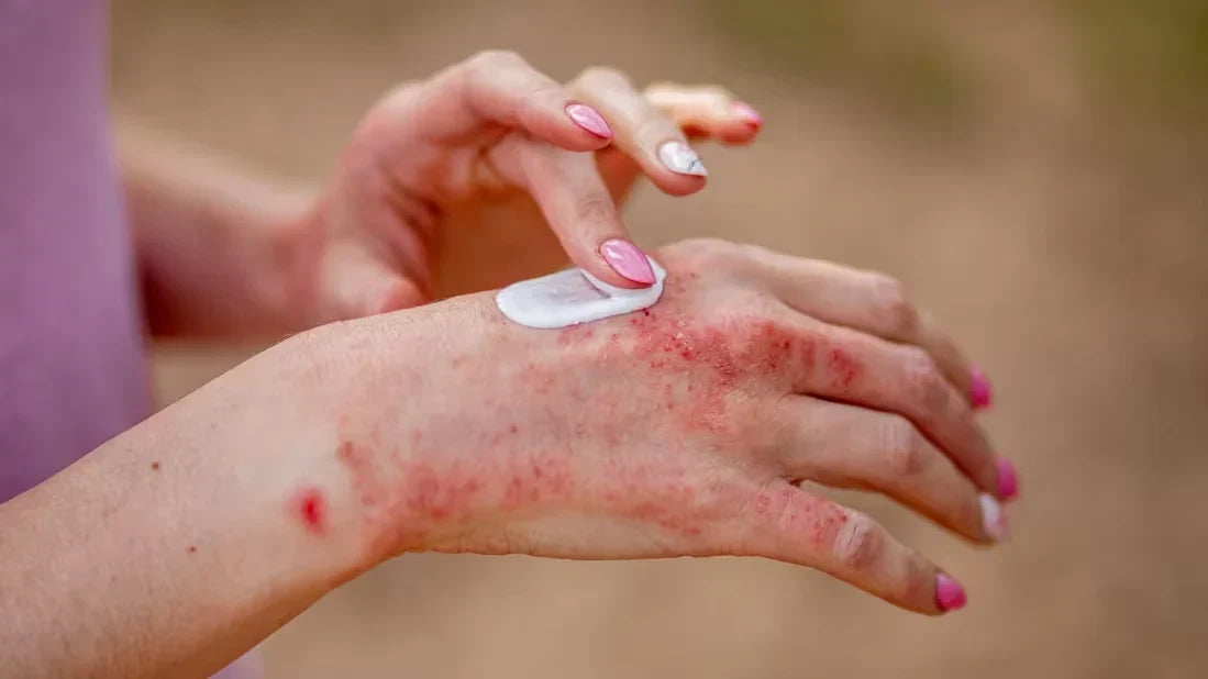 "Red, inflamed eczema rash on the hand treated with topical cream, illustrating skincare for irritated skin."