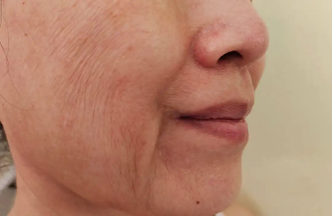 Illustration of cross-linked elastin fibers forming an elastic network within the skin dermis